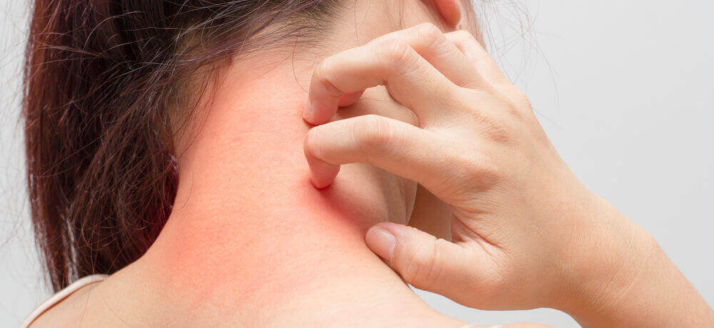 Woman scratching irritated eczema on the back of her neck